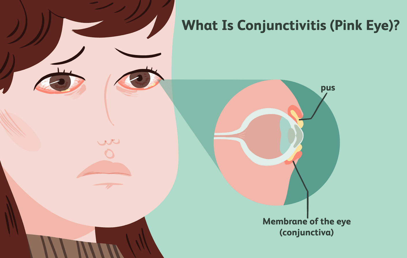 Conjunctivitis: Symptoms and Treatment